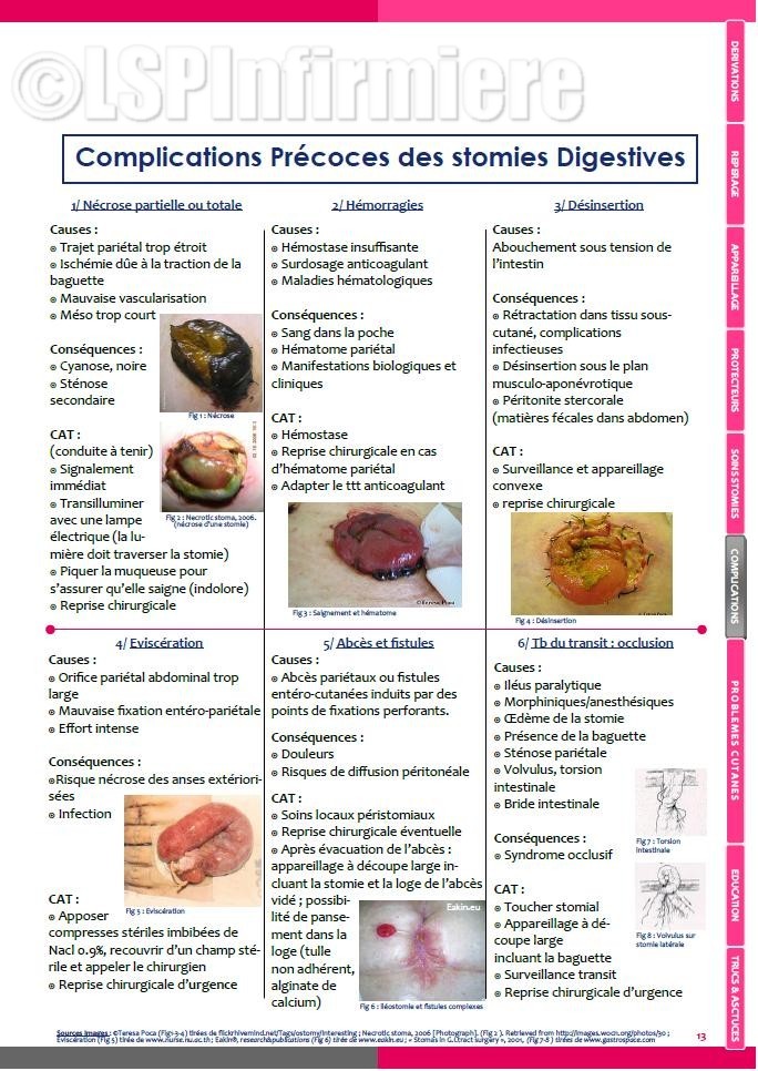 Complications precoces stomies digestives