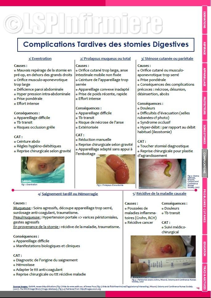 Complications tardives stomies digestives